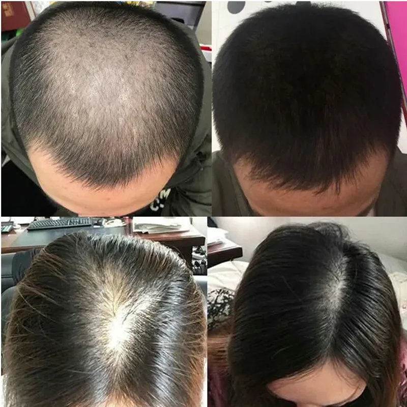Жидкость для роста волос Overl – обзор и цена Hair Care Or Haircare